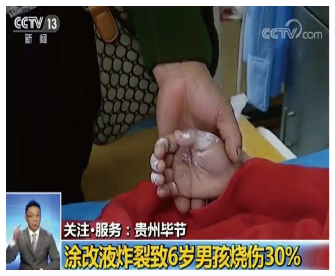 常见文具竟导致6岁男孩烧伤-03.jpg
